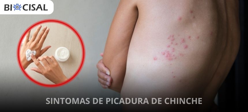 sintomas-de-picadura-de-chinche